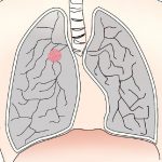 がんの肺転移がわかった時に知っておくべきことや余命は？