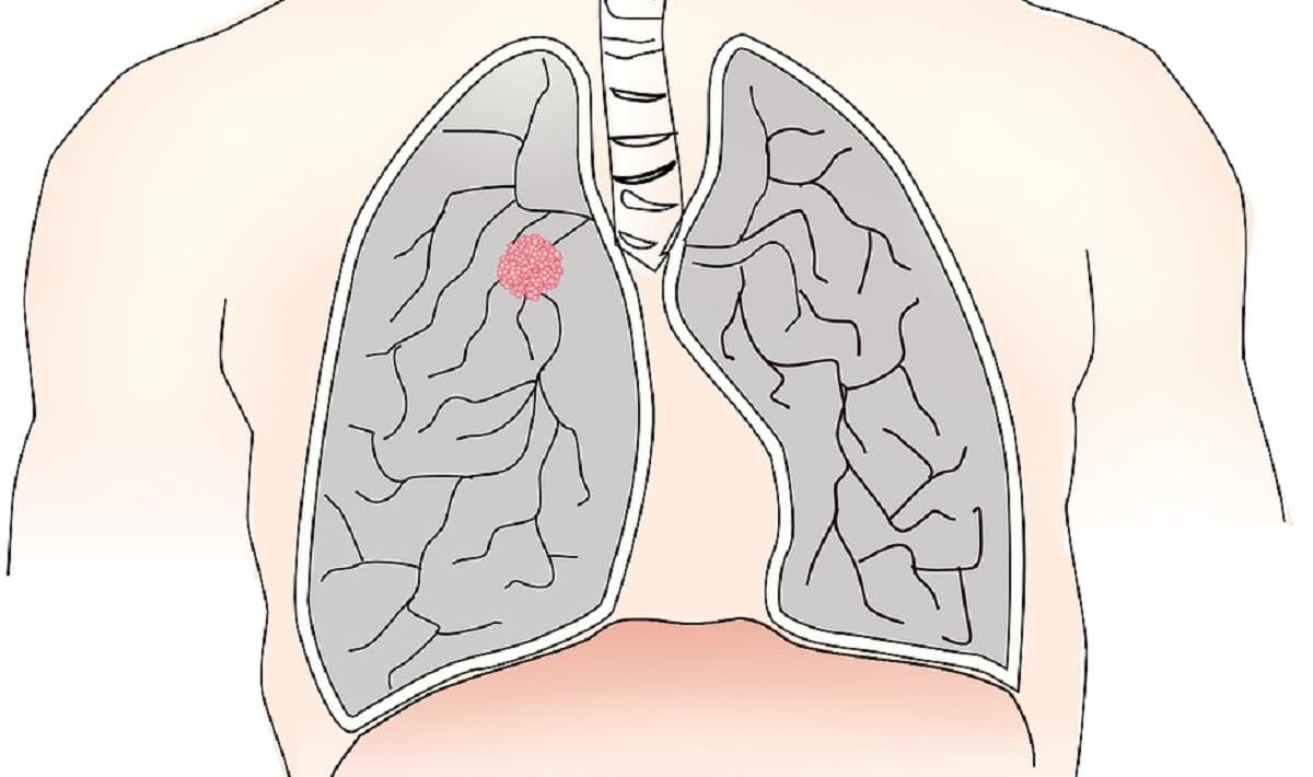 肺がん ステージ 4 余命 宣告