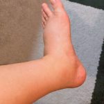 がん治療後にリンパ浮腫がつらいとき｜まず相談できる場所と考え方を専門医が解説