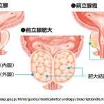 前立腺がん・精巣がん　男性特有のがんの不安と緩和ケア