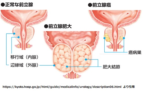 前立腺がんの緩和ケア