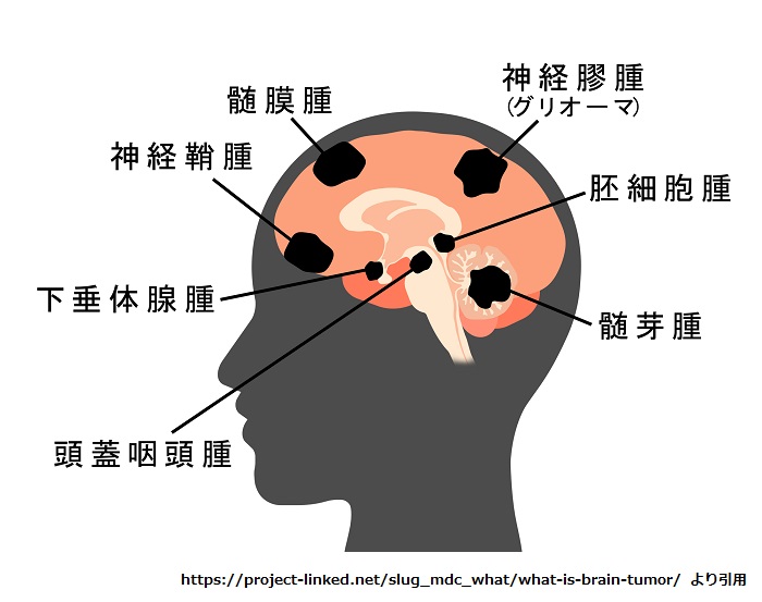 脳腫瘍と緩和ケア